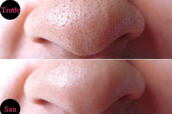 Sợi Bã Nhờn là gì? Cách trị sạch bã nhờn trên Mũi, Cằm, Mặt