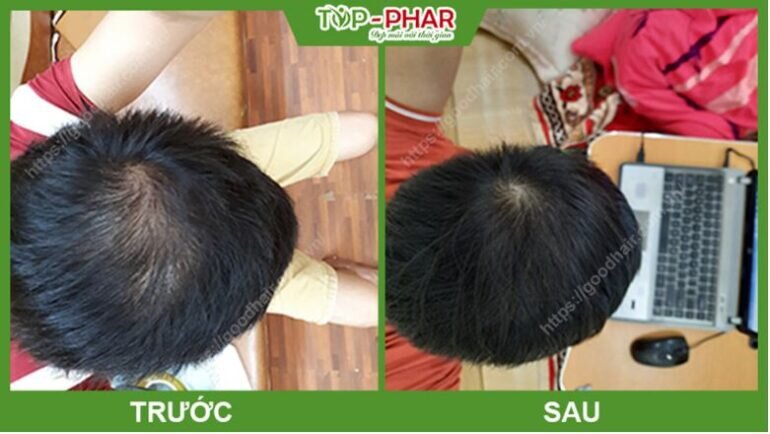 Đánh giá viên uống mọc tóc GoodHair có tốt không?