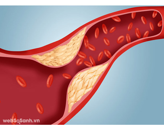 Giảm cholestrol góp phần giảm các bệnh tim mạch