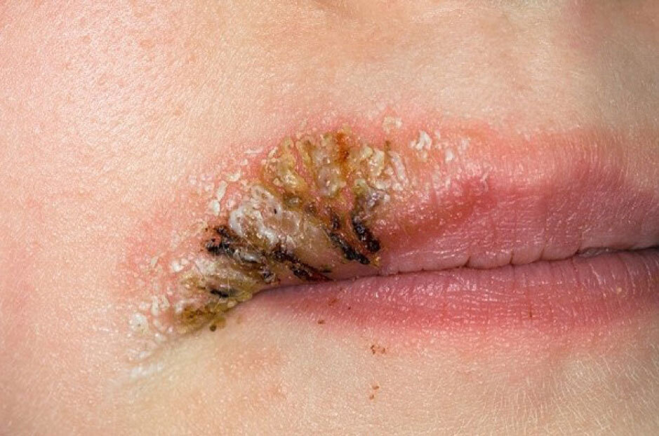 Nhiễm trùng tại chỗ phun xăm là một trong những nguy cơ dễ để lại sẹo xấu trên môi.