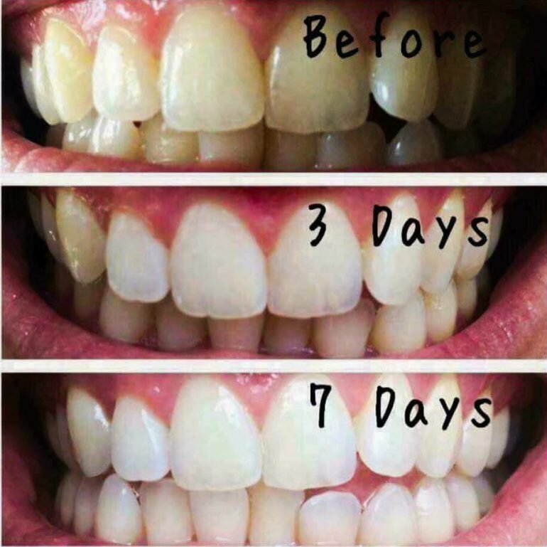 Hút thuốc vàng răng dùng kem đánh răng ap24 của Mỹ có trắng không ?