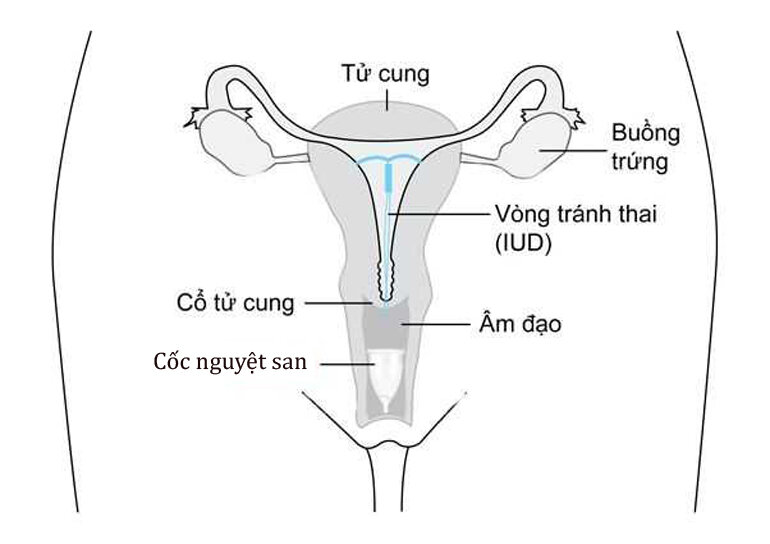 Cốc nguyệt san có khiến âm đạo bị rộng ra ?