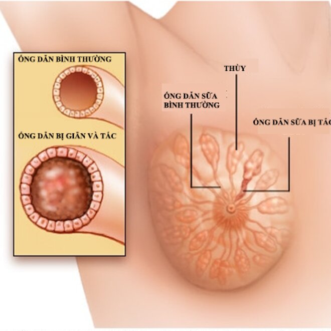 Tia sữa bị tắc hoàn toàn