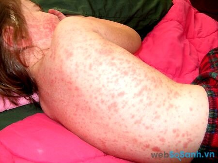 Xuất huyết dưới da là một trong những triệu chứng bệnh sốt xuất huyết (nguồn: internet)