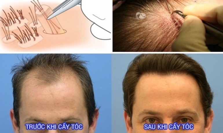 Cách chữa rụng tóc di truyền cho người bị hói lâu năm