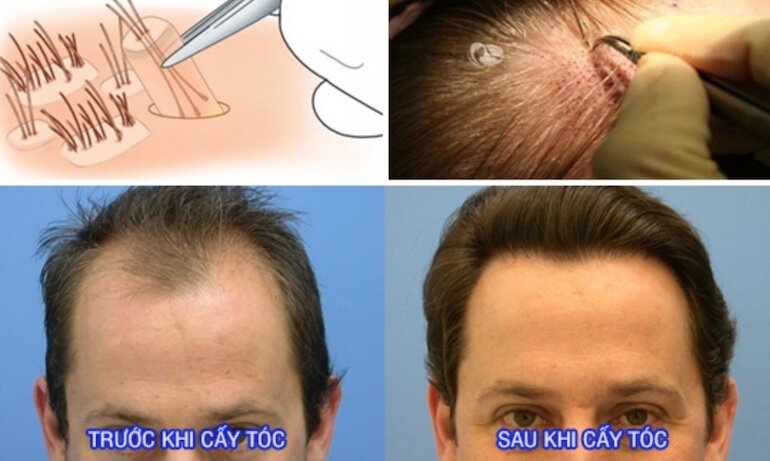 Bằng việc lấy chính nang tóc trên da đầu để cấy vào vị trí bị thiếu hoặc rụng nhiều