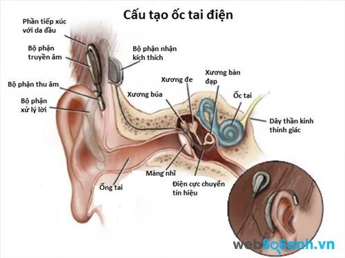 Cấu tạo ốc tai điện tử khi được gắn vào tai người