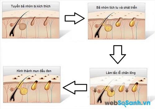 Các loại mụn đầu đen, mụn cám thường hình thành do 