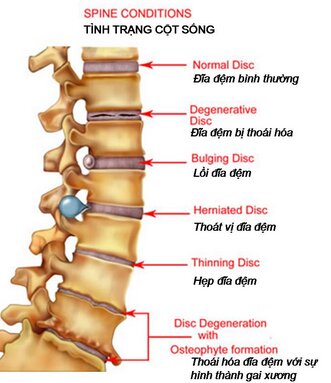 Giúp chữa trị thoái hóa đốt sống cổ