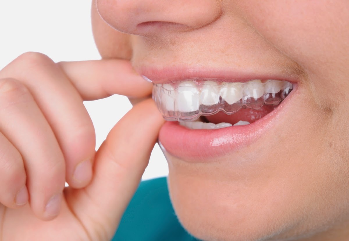 Đeo máng răng rất an toàn cho việc chăm sóc răng miệng tiện lợi tháo lắp, vệ sinh 