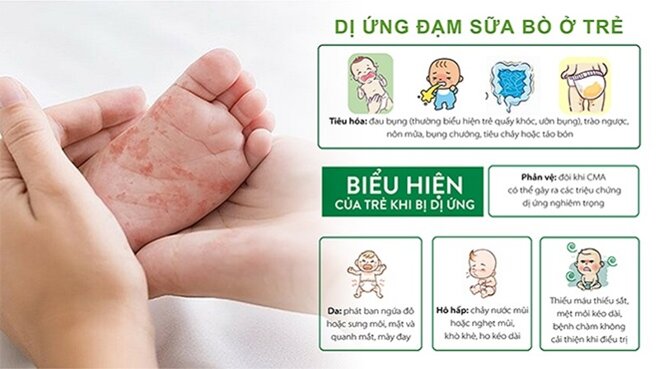 Tất tật những điều cần biết về sữa Meiji HP dành cho trẻ dị ứng đạm sữa bò