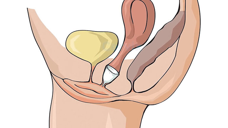 Cốc nguyệt san sẽ làm rách màng trinh