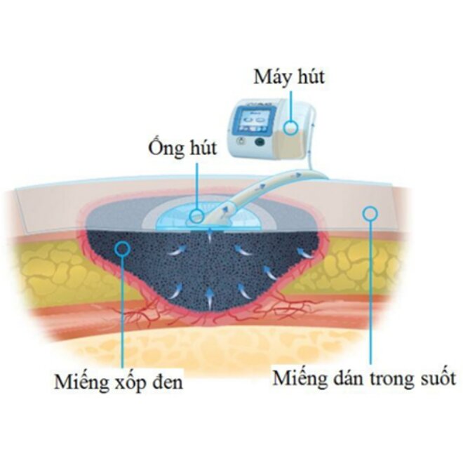 Nguyên tắc hoạt động của máy hút dịch điều trị vết thương