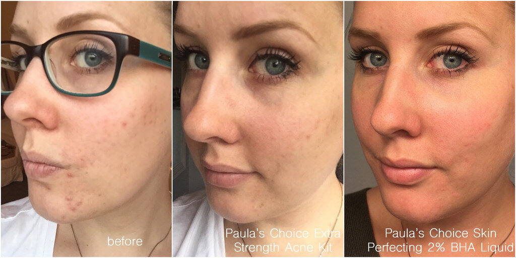Sử dụng sản phẩm chăm sóc da của Paula's Choice bạn sẽ thấy làn da của mình được cải thiện rõ rệt