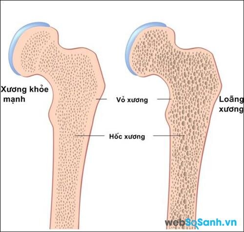 Thiếu canxi làm xương dễ gãy