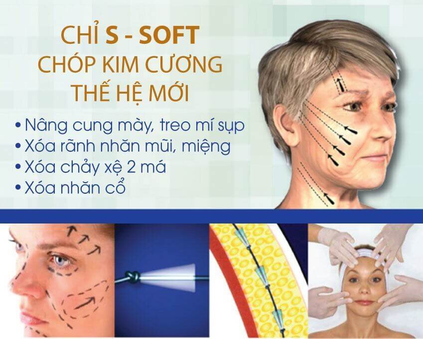 Nâng cơ mặt bằng chỉ S-Soft