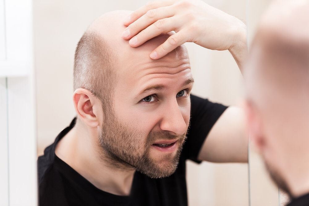 Rụng tóc ở nam giới: Nguyên nhân và các mẹo kích thích mọc tóc