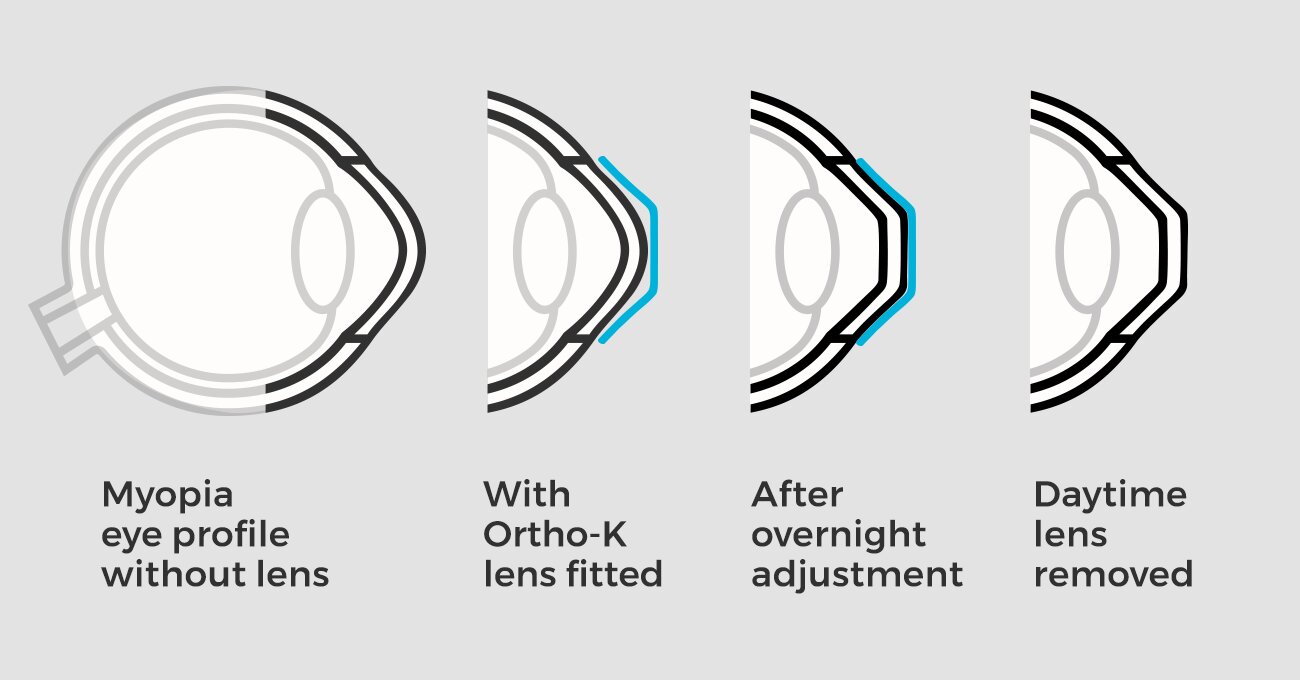 Rất Hay Ortho K là gì, kính orthok giá bao nhiêu tiền, hướng dẫn cách