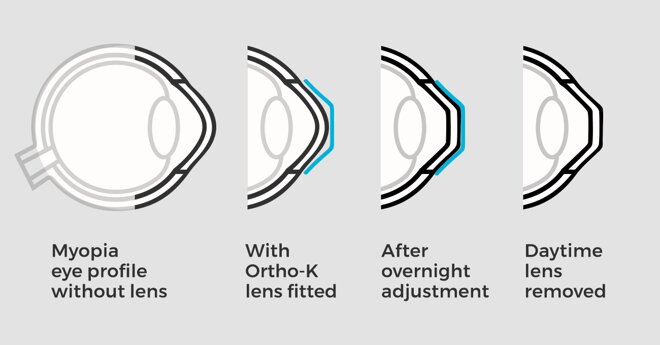 Kính Ortho-K với cơ chế đặc biệt, điều chỉnh giác mạc vào mỗi đêm