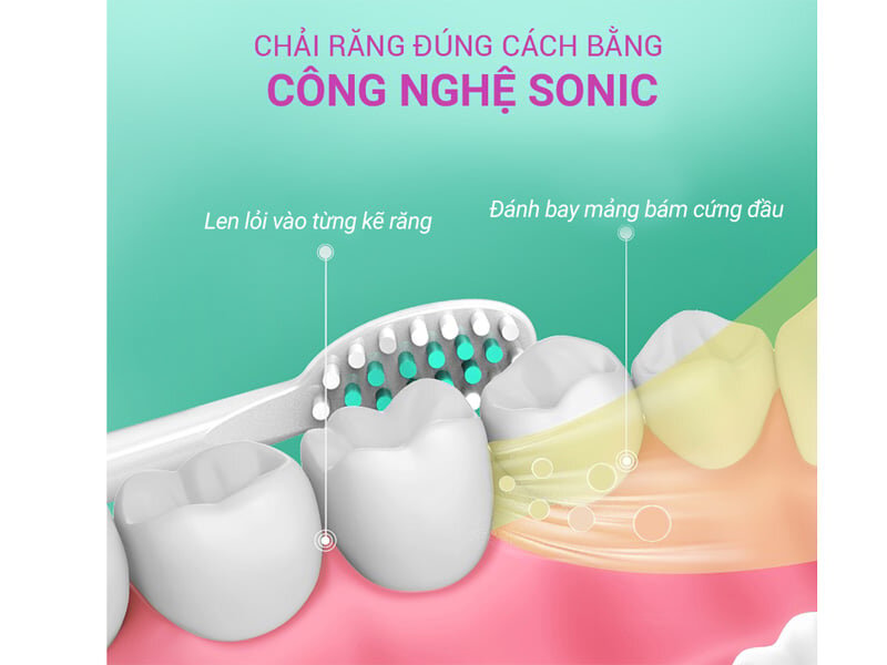 Công nghệ sóng siêu âm làm sạch các mảng bám trên răng