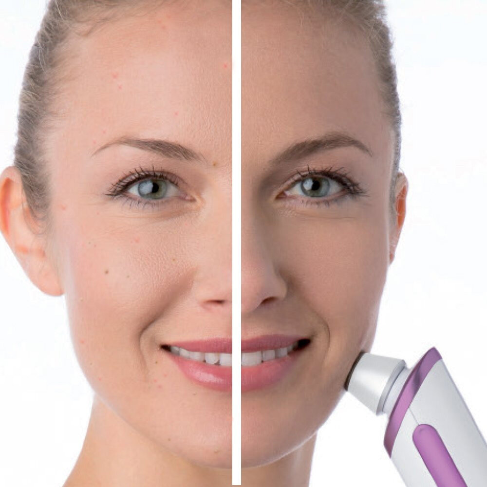 Máy hút mụn và tẩy tế bào chết Beurer FC76