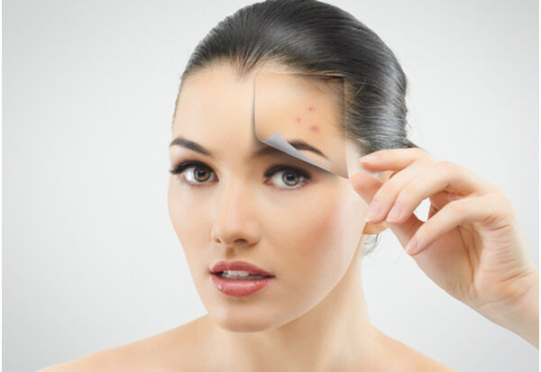 10 phương pháp giúp ngăn ngừa hiệu quả sự hình thành của mụn