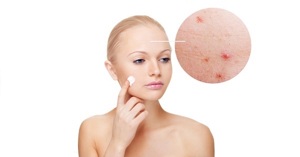 2 tiêu chí giúp bạn lựa chọn kem trị mụn hiệu quả cho da dầu