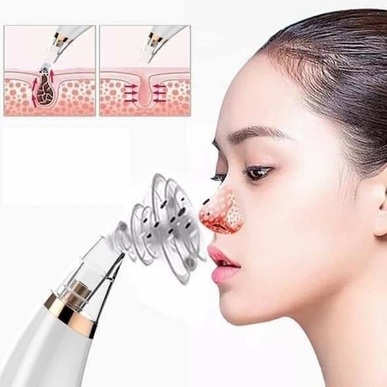 Nặn mụn để trả lại vẻ đẹp cho làn da 