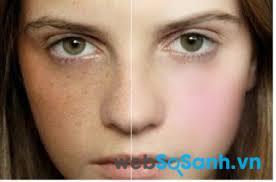 6 Cách trị nám tàn nhang hiệu quả bất ngờ từ thiên nhiên