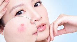 6 sản phẩm trị mụn giá rẻ bình dân mà chất lượng bất ngờ