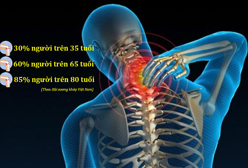 Khối lượng xương đang mất dần đi sau 40 tuổi, dù bạn không biết