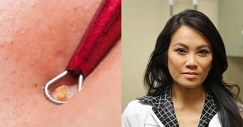 Bác sĩ “nặn mụn” nổi tiếng nhất thế giới tiết lộ 9 nguyên tắc xử lý mụn nhất định phải học hỏi