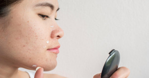 Các thành phần cần chú ý trong kem dưỡng ẩm cho da mụn