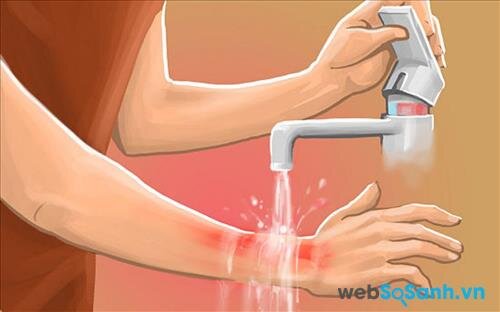 Cách sơ cứu cấp tốc khi chẳng may bị bỏng nhiệt độ