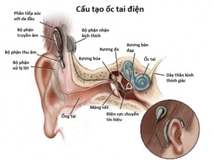 Cấu tạo và nguyên lý làm việc của ốc tai điện tử