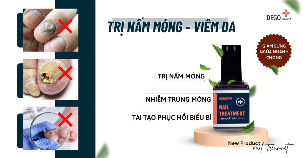 Dego Pharma Nail Treatment: Sản phẩm điều trị nấm móng hiệu quả nhất hiện nay