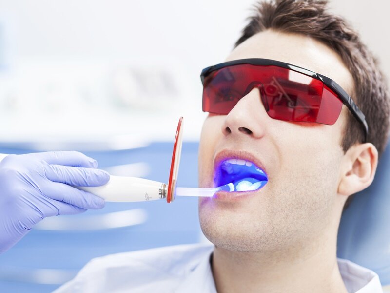 Lựa chọn phương pháp tẩy răng phù hợp với tình trạng răng của mình
