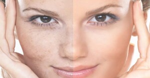 Giới thiệu 4 sản phẩm kem trị nám, tàn nhang hiệu quả