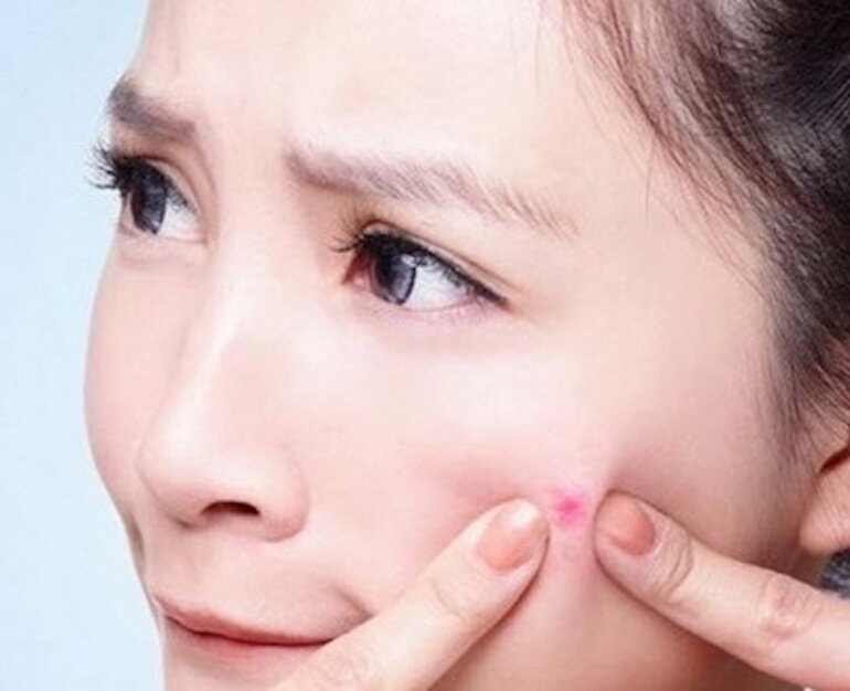 Lựa chọn những thương hiệu uy tín để mang đến hiệu quả trị mụn
