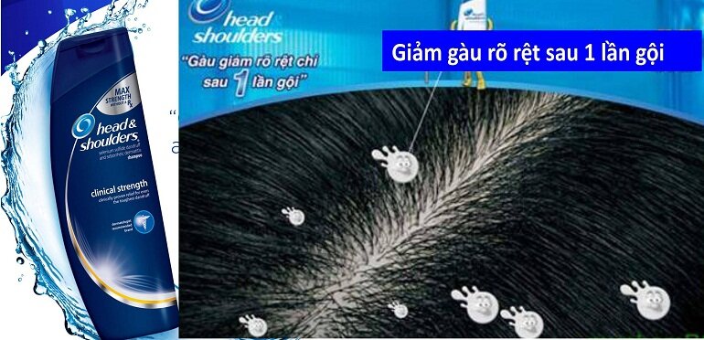 dầu gội Head and Shoulder trị gàu của Mỹ có tốt không?