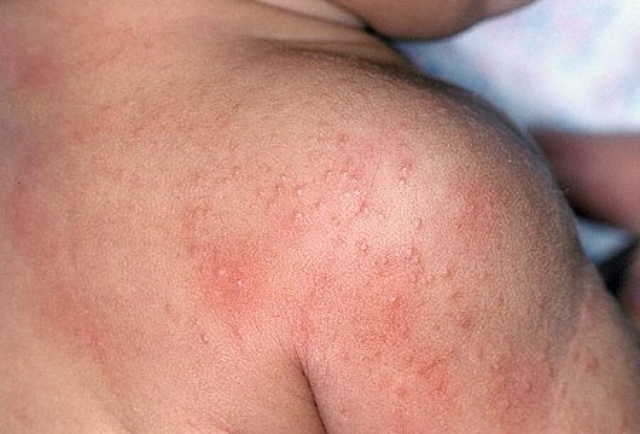 Những mẩn đỏ nổi khắp cơ thể khi trẻ bị rôm sảy