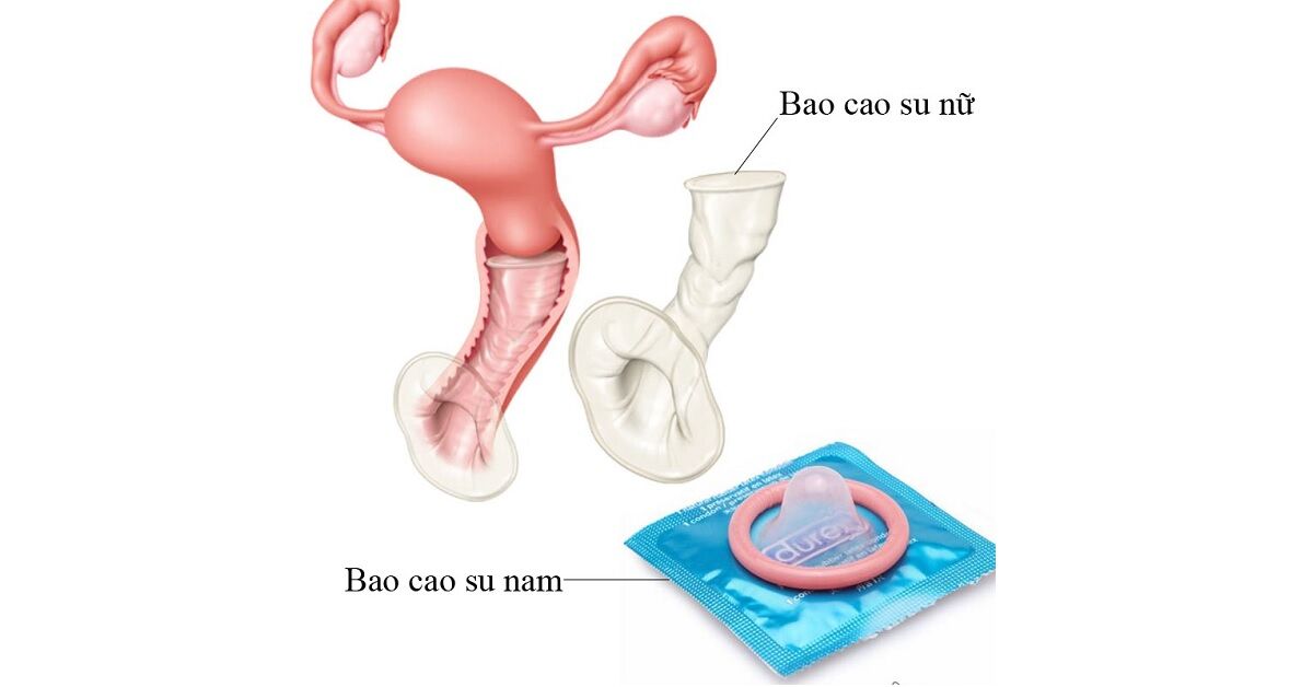 Khái niệm, công dụng của bao cao su và sự khác biệt giữa bao cao su nam nữ