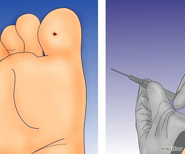 Làm thế nào để loại bỏ mụn cóc