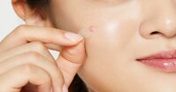 Miếng dán mụn có tác dụng gì? Cần lưu ý gì khi sử dụng?