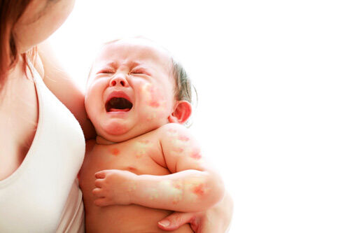 Những loại sữa bột an toàn với trẻ dị ứng đạm sữa bò