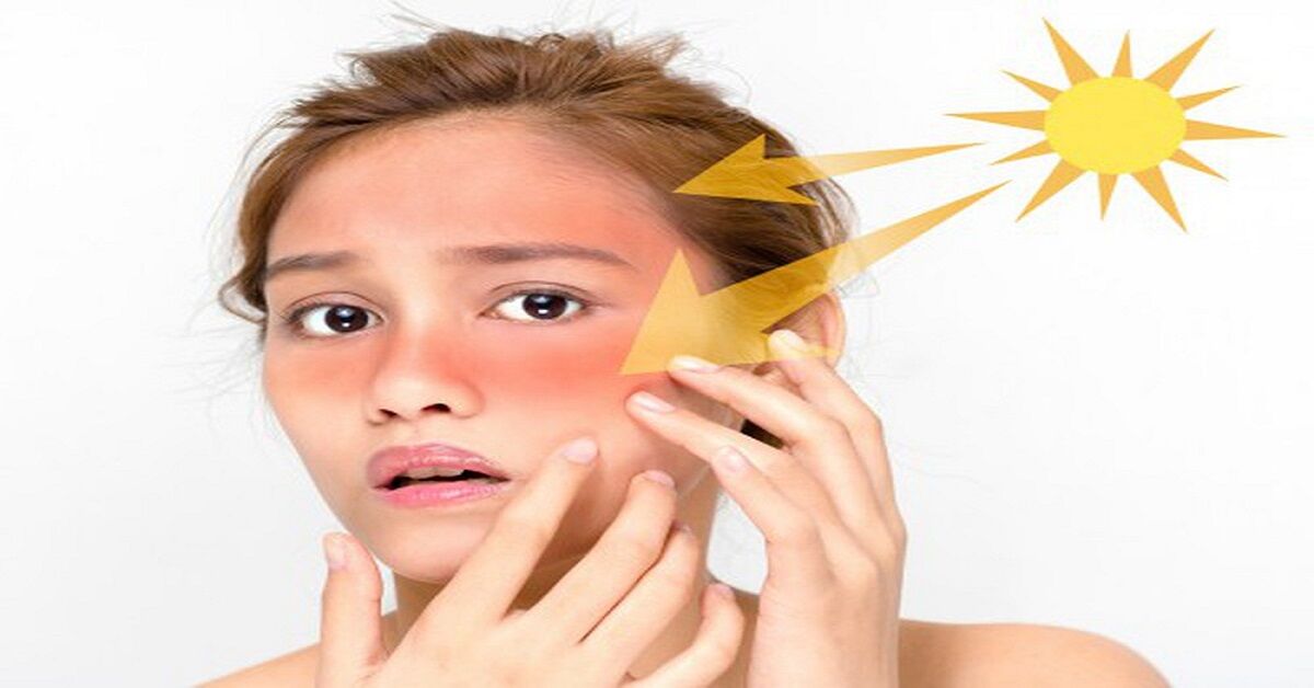 Những tác dụng và cách chọn kem chống nắng cho da mụn