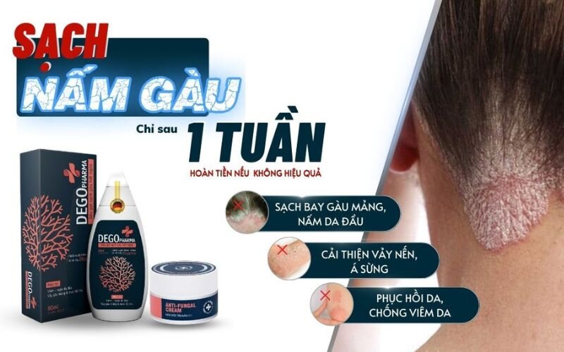 Dầu gội đầu trị nấm Dego Pharma 80ml