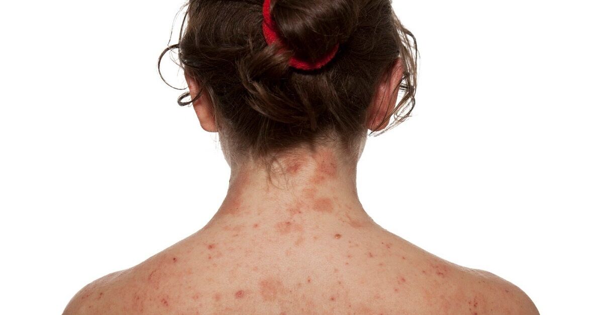 Review 3 sữa tắm trị mụn lưng tốt nhất hiện nay