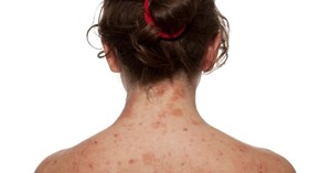 Review 3 sữa tắm trị mụn lưng tốt nhất hiện nay