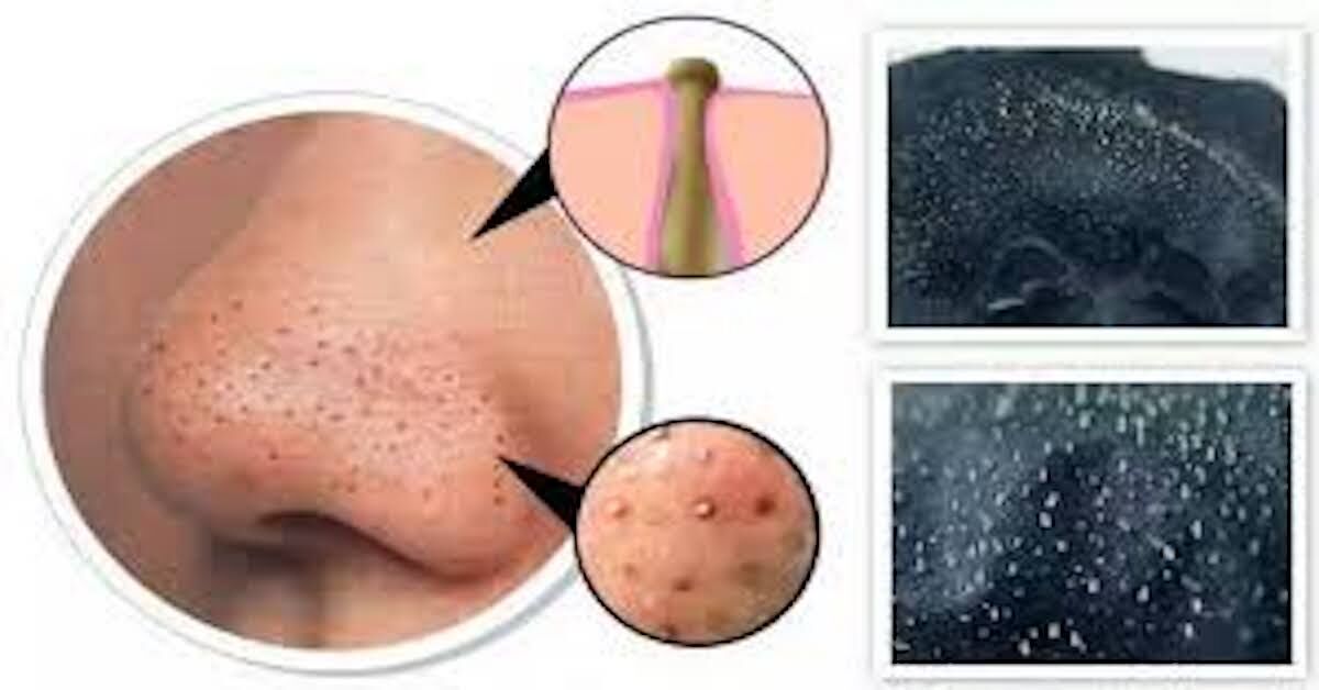 Review miếng dán mụn đầu đen “thần thánh” được yêu chuộng nhất hiện nay